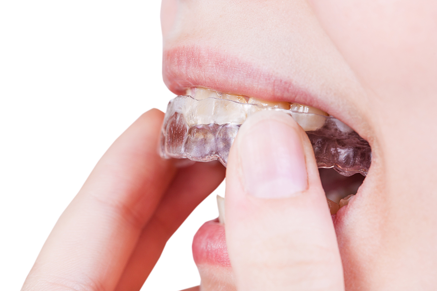 What Can Invisalign Aligners Address?