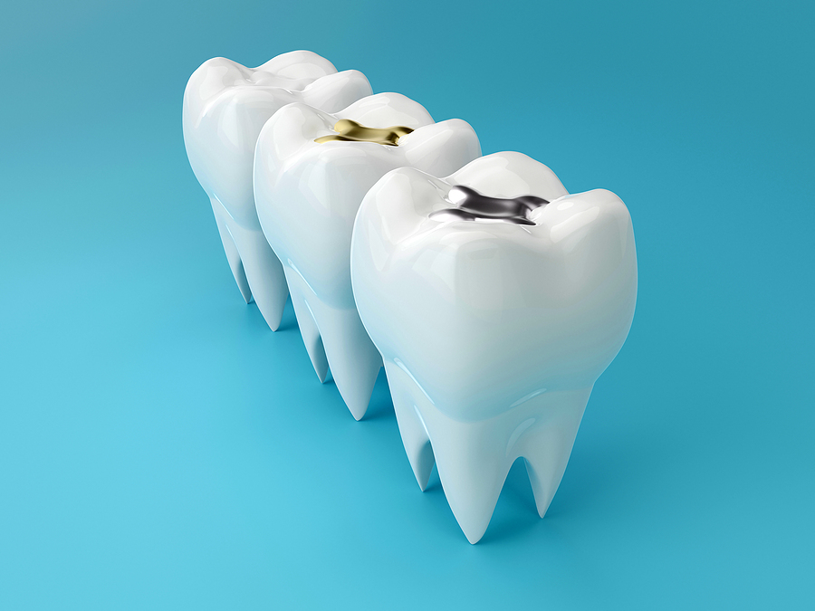 Comprehensive Solutions for Restorative Dentistry: Dental Fillings and Dentures in Almaden, CA