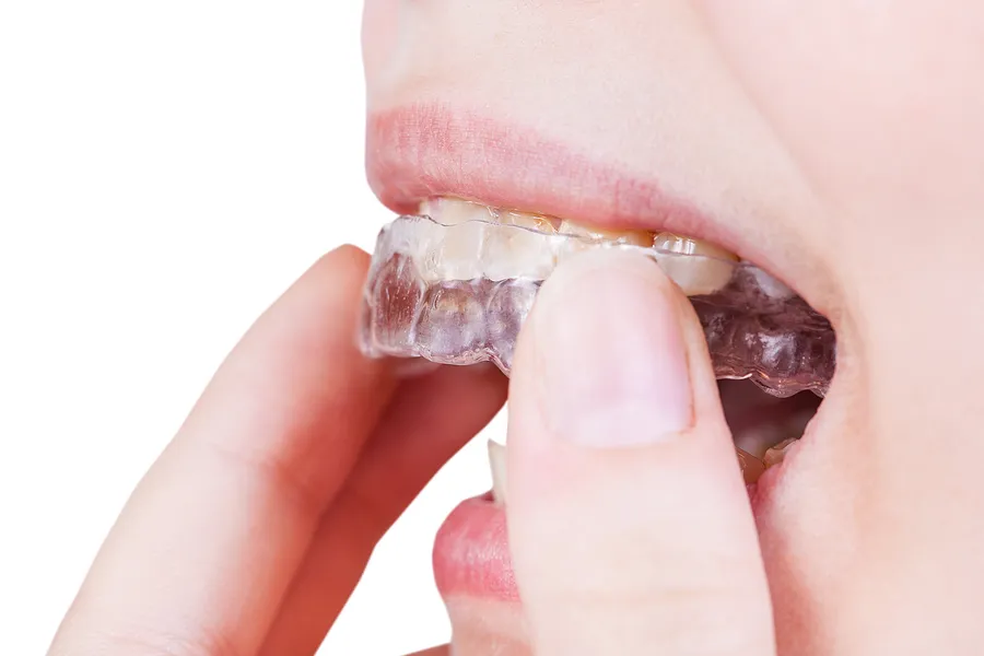 What Can Invisalign Aligners Address in Almaden CA?